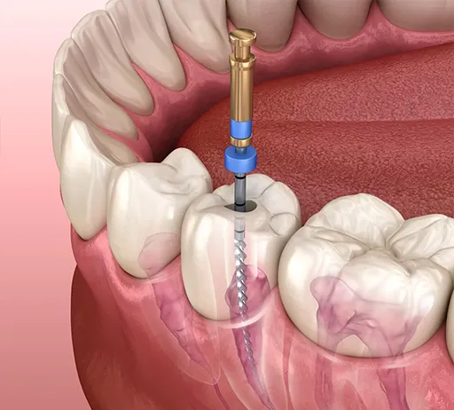 endodoncia